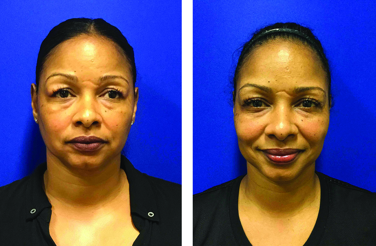 Blepharoplasty Lafayette, La - Plastic Surgeon 